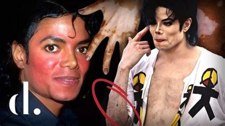 Michael Jackson's Vitiligo: Unveiling the Truth Behind His Skin Condition